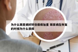 為什么銀屑病好轉(zhuǎn)但瘙癢加重 銀屑病在恢復的時候為什么很癢