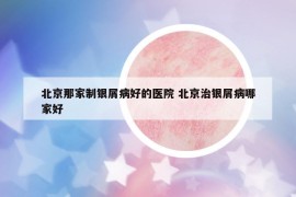 北京那家制銀屑病好的醫(yī)院 北京治銀屑病哪家好