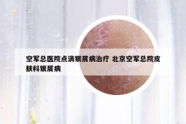 空軍總醫(yī)院點滴銀屑病治療 北京空軍總院皮膚科銀屑病