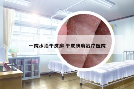一院水治牛皮癬 牛皮膚癬治療醫(yī)院