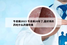 牛皮癬2023 牛皮癬20年了,最好用的藥吃什么藥健效果