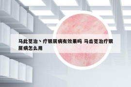 馬此莧治丶療銀屑病有效果嗎 馬齒莧治療銀屑病怎么用