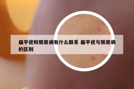 扁平疣和銀屑病有什么聯(lián)系 扁平疣與銀屑病的區(qū)別