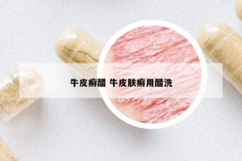牛皮癬醋 牛皮膚癬用醋洗