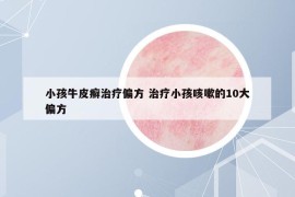 小孩牛皮癬治療偏方 治療小孩咳嗽的10大偏方