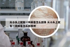 從小頭上就有一塊癬是怎么回事 從小頭上就有一塊癬是怎么回事啊