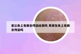 老公身上有癬會(huì)傳染給我嗎 男朋友身上有癬會(huì)傳染嗎