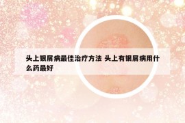 頭上銀屑病最佳治療方法 頭上有銀屑病用什么藥最好