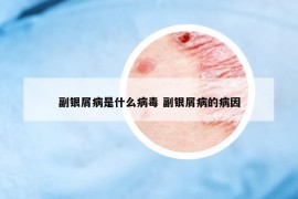 副銀屑病是什么病毒 副銀屑病的病因