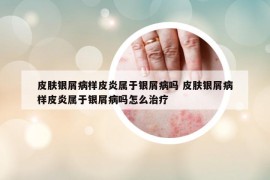 皮膚銀屑病樣皮炎屬于銀屑病嗎 皮膚銀屑病樣皮炎屬于銀屑病嗎怎么治療