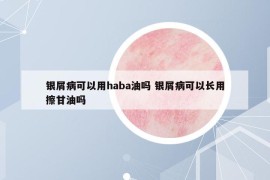 銀屑病可以用haba油嗎 銀屑病可以長用擦甘油嗎