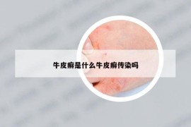 牛皮癬是什么牛皮癬傳染嗎