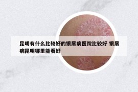 昆明有什么比較好的銀屑病醫(yī)院比較好 銀屑病昆明哪里能看好