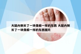 大腿內(nèi)側(cè)長(zhǎng)了一塊像癬一樣的東西 大腿內(nèi)側(cè)長(zhǎng)了一塊像癬一樣的東西圖片