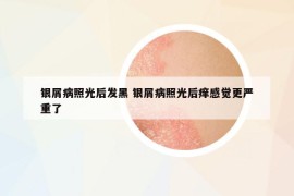 銀屑病照光后發(fā)黑 銀屑病照光后癢感覺更嚴(yán)重了