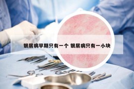 銀屑病早期只有一個 銀屑病只有一小塊