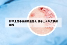 脖子上像牛皮癬的是什么 脖子上長牛皮膚癬圖片