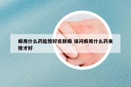 癬用什么藥能擦好皮膚癬 請(qǐng)問癬用什么藥來擦才好