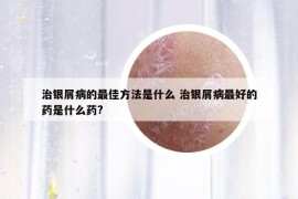 治銀屑病的最佳方法是什么 治銀屑病最好的藥是什么藥?