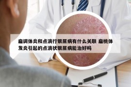 扁調(diào)體炎和點滴行銀屑病有什么關(guān)聯(lián) 扁桃體發(fā)炎引起的點滴狀銀屑病能治好嗎
