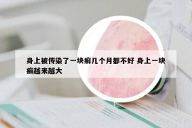 身上被傳染了一塊癬幾個月都不好 身上一塊癬越來越大