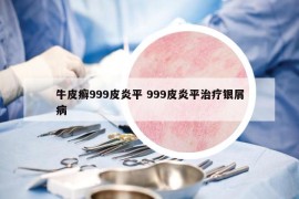 牛皮癬999皮炎平 999皮炎平治療銀屑病