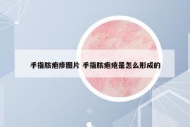 手指膿皰疹圖片 手指膿皰瘡是怎么形成的