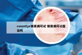 cosentyx銀屑病可試 銀屑病可以醫(yī)治嗎