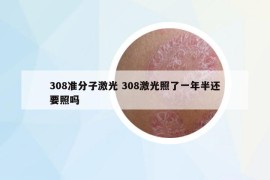 308準(zhǔn)分子激光 308激光照了一年半還要照嗎