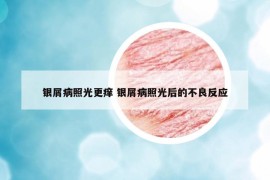 銀屑病照光更癢 銀屑病照光后的不良反應(yīng)