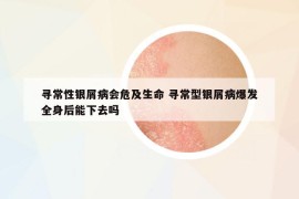 尋常性銀屑病會危及生命 尋常型銀屑病爆發(fā)全身后能下去嗎