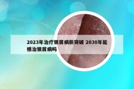 2023年治療銀屑病新突破 2030年能根治銀屑病嗎