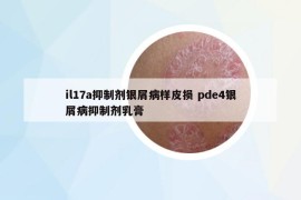 il17a抑制劑銀屑病樣皮損 pde4銀屑病抑制劑乳膏