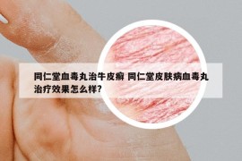 同仁堂血毒丸治牛皮癬 同仁堂皮膚病血毒丸治療效果怎么樣?