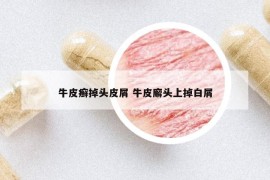 牛皮癬掉頭皮屑 牛皮廨頭上掉白屑