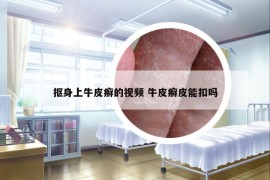 摳身上牛皮癬的視頻 牛皮癬皮能扣嗎