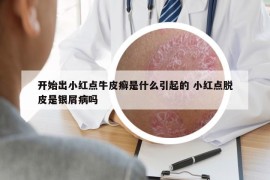 開始出小紅點牛皮癬是什么引起的 小紅點脫皮是銀屑病嗎