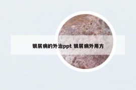 銀屑病的外治ppt 銀屑病外用方