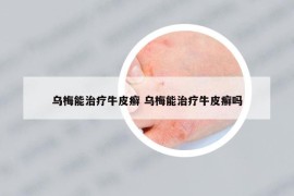 烏梅能治療牛皮癬 烏梅能治療牛皮癬嗎