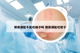 銀屑病能不能吃橘子嗎 銀屑病能吃橙子