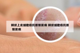 鱗狀上皮細(xì)胞癌抗原銀屑病 鱗狀細(xì)胞癌抗原 銀屑病