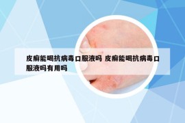 皮癬能喝抗病毒口服液嗎 皮癬能喝抗病毒口服液嗎有用嗎