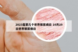2023是第幾個(gè)世界銀屑病日 10月29日世界銀屑病日