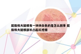 屁股和大腿根有一塊塊白色的是怎么回事 屁股和大腿根部長(zhǎng)凸起紅疙瘩