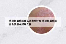 頭皮銀屑病洗什么洗發(fā)水好呢 頭皮銀屑病洗什么洗發(fā)水好呢女性