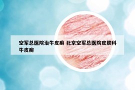 空軍總醫(yī)院治牛皮癬 北京空軍總醫(yī)院皮膚科牛皮癬