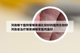 河南哪個醫(yī)院看銀屑病比較好的醫(yī)院比較好 河南省治療銀屑病哪家醫(yī)院最好