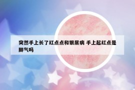 突然手上長了紅點(diǎn)點(diǎn)和銀屑病 手上起紅點(diǎn)是腳氣嗎