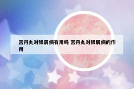 苦丹丸對銀屑病有用嗎 苦丹丸對銀屑病的作用