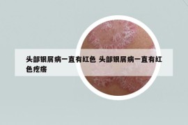 頭部銀屑病一直有紅色 頭部銀屑病一直有紅色疙瘩